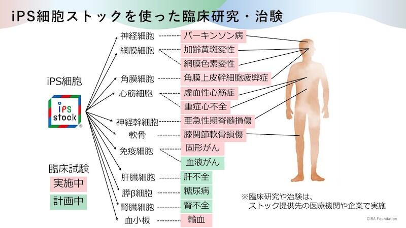 脳や目の疾患をはじめ、脊髄、心臓、血液、がん、軟骨、筋肉……、とさまざまな疾患で、iPS細胞ストック(iPS財団提供のiPS細胞)を用いた臨床研究が進められている。